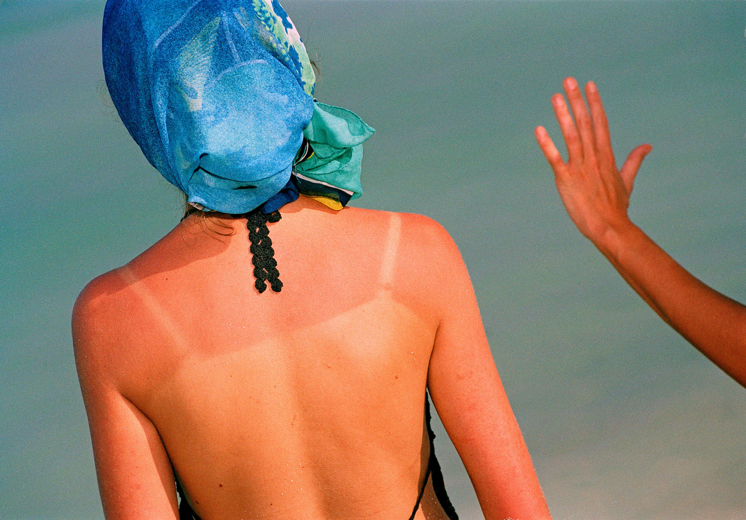 sunburn