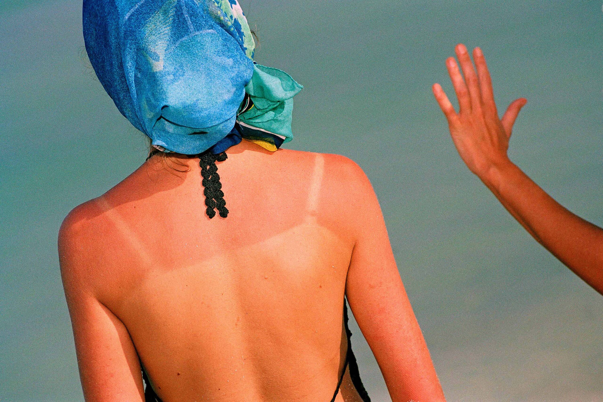 WREN-DougieWallace-sunburn